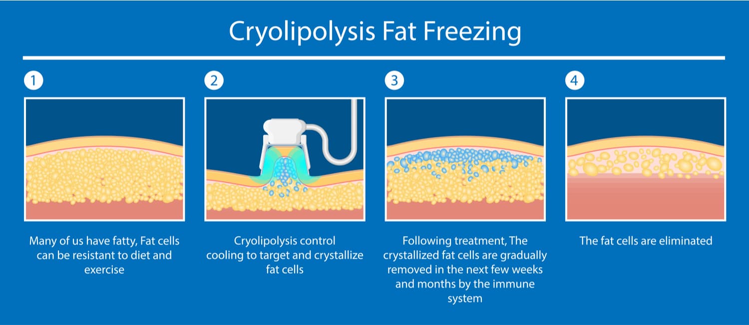 cryolipolyse