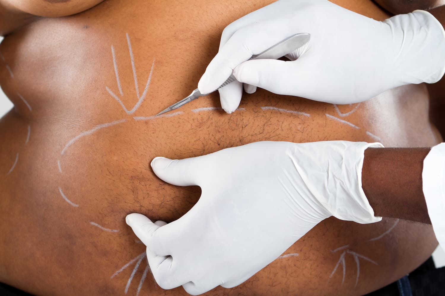 Guide pratique de la liposuccion