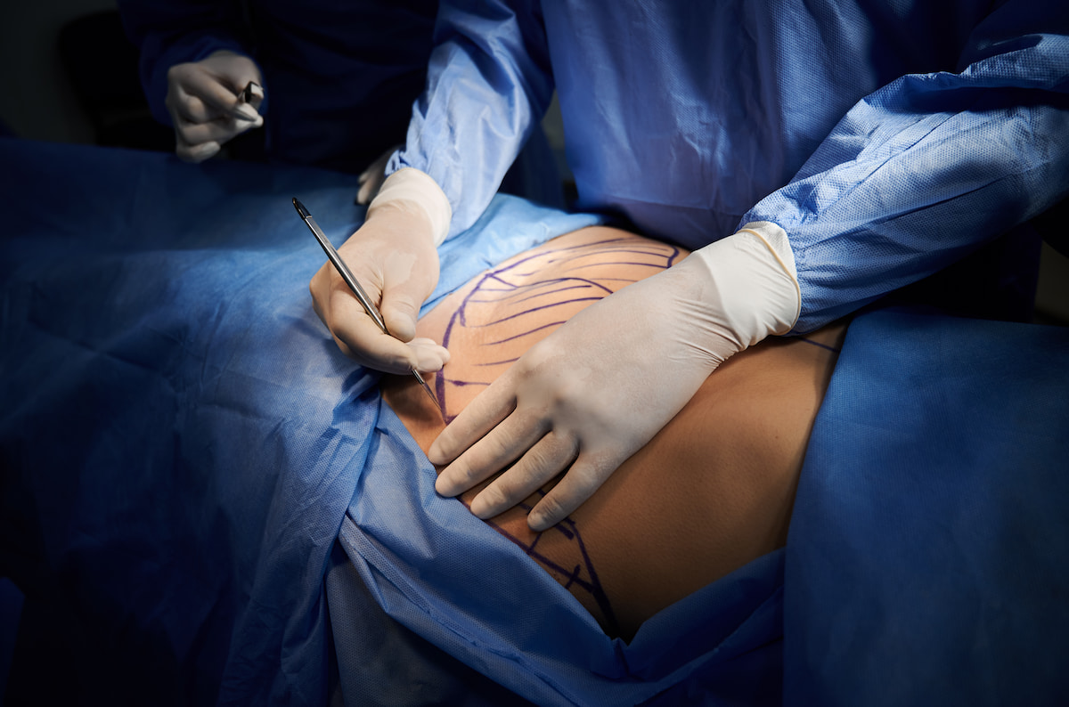 Que faut-il attendre d’une abdominoplastie ?