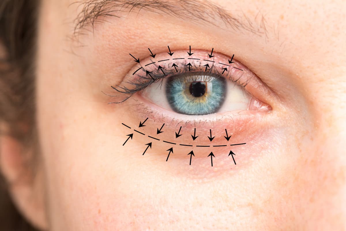 Tout savoir sur la blépharoplastie